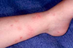 Enfermedades que transmiten las picaduras de pulgas en humanos